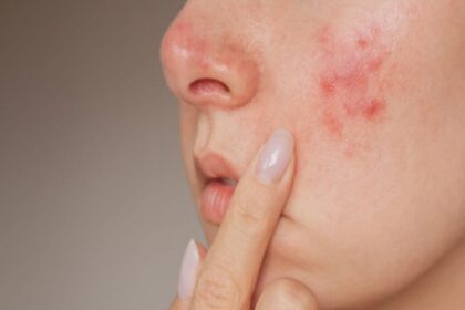 Skin Care Tips: बार-बार हो रही है मुंहासों की समस्या, ये हो सकते हैं कारण, आप जानें